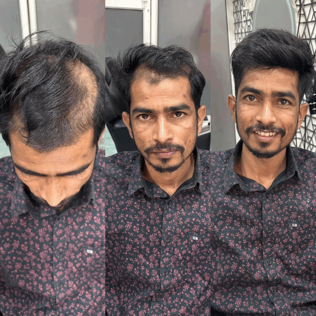 best hair patch services in Viman Nagar Pune