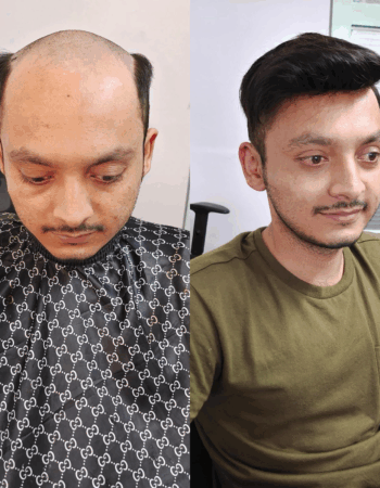 Best Hair Patch Replacement, Hair Wigs Services in Viman Nagar Pune